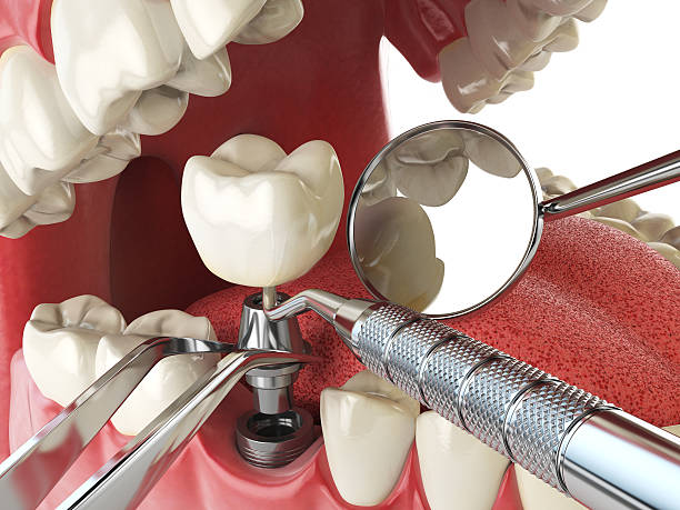 Best Broken or Chipped Tooth Repair in Cadiz, KY